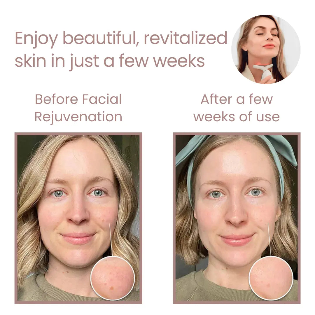 Dispositivo de Rejuvenecimiento Facial